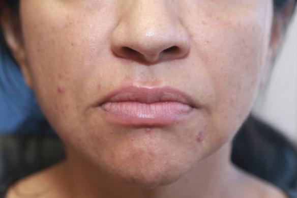 Lip enlargement and augmentation with Juvederm Ultra XC